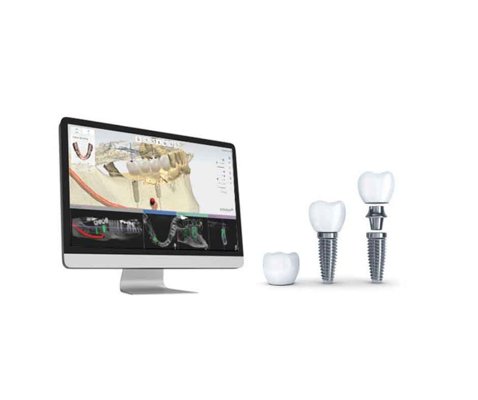 Computer-Aided 3D Technology Based Dental Implants Hoppers Crossing