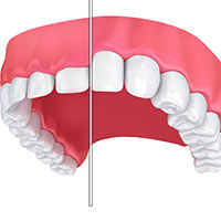 Dental Treatment 1: Gum Recontouring