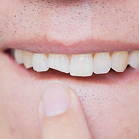 Chipped Teeth-how can get a Slight breakages of my tooth fixed - Hoppers Crossing Dentist