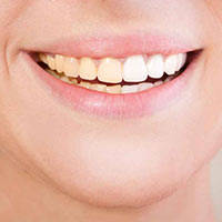 Discoloured Teeth-Dull teeth-Discoloration-Hoppers Crossing dentists