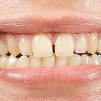 Teeth Spacing-Odd gaps between teeth-Improper teeth spacing