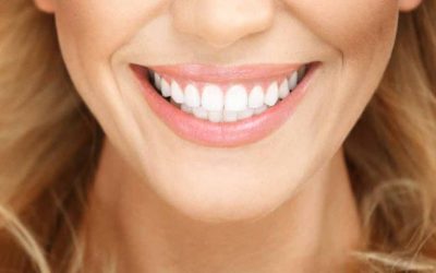 How to look after your composite resin veneers in Hoppers Crossing –5 tips